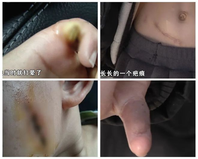 ！5岁儿童爬空调外机瞬间晕厥！九游会网址是多少肌腱都打断了(图2)